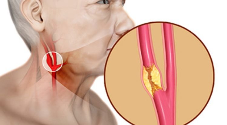 Carotid Artery Disease Symptoms CNC Health Info