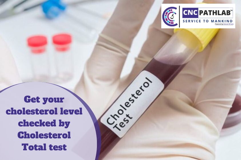 Get your Cholesterol Level checked By Cholesterol Total Test