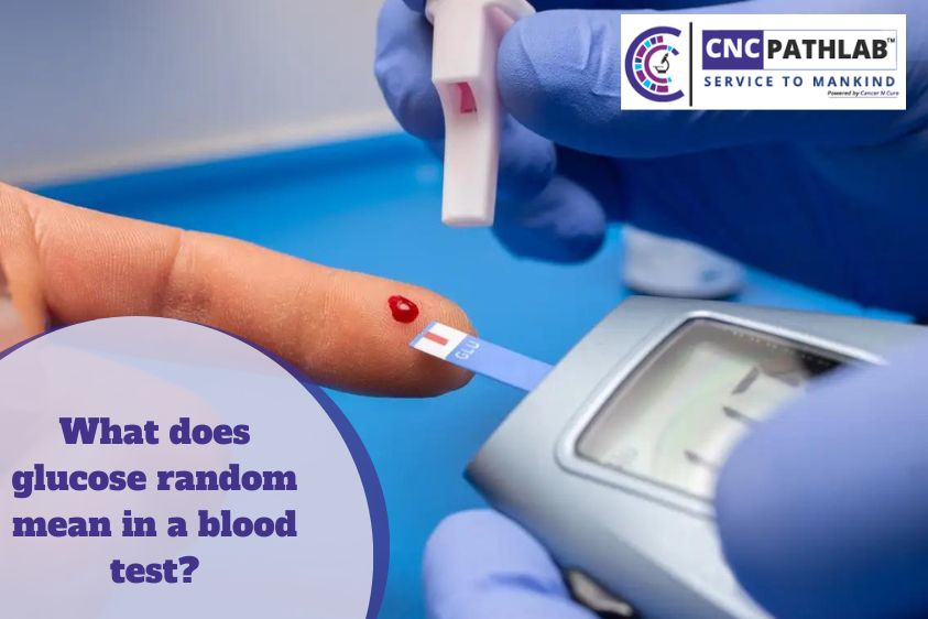 how to test random blood sugar